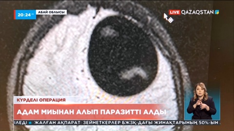 Cемейлік дәрігерлер адам миынан алып паразитті алды