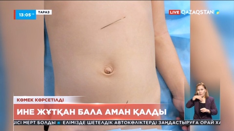 Тараздық дәрігерлер бірнеше ине жұтып қойған бүлдіршінді аман алып қалды