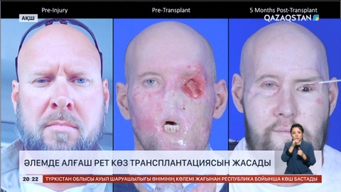 Әлемде алғаш рет көз трансплантациясы жасалды