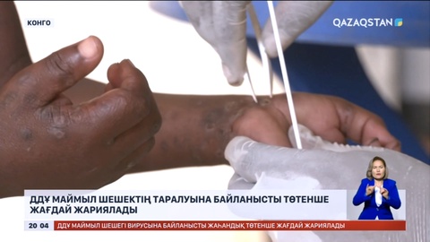 Маймыл шешек вирусының белгілері тұмауға ұқсайды