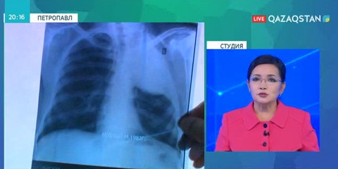 Петропавлда ашық туберкулезбен ауырғандардың өкпесіне силикон орнатылуда