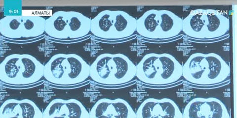 Қатерлі ісікті ерте анықтау науқасты емдеуді жеңілдетеді