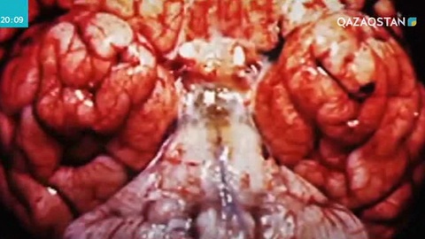 Менингококк инфекциясы несімен қауіпті?