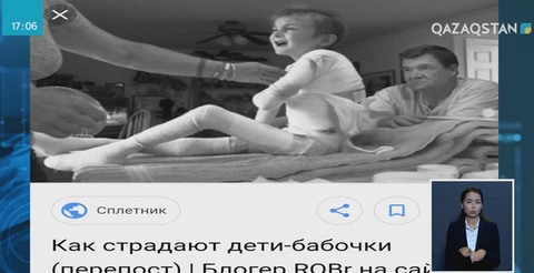 Елімізде 76 адам көбелек синдромына шалдыққан