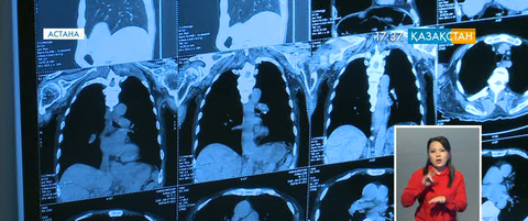 Қазақстанда 144 мыңға жуық адам қатерлі дертке шалдыққан