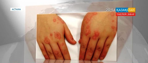 Елімізде әрбір бесінші адам аллергияға шалдыққан