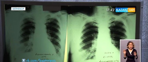 Отандық мамандар өкпе ауыстыруға дайын