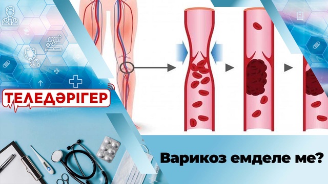 Варикоз емделе ме?