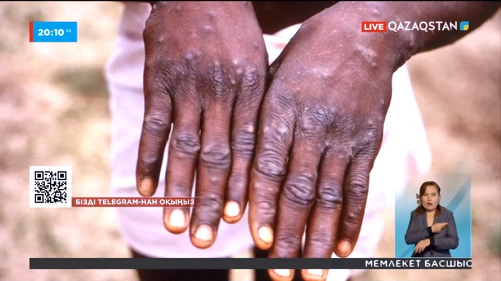 Маймыл шешек ауруы әлемнің 12 еліне тарады