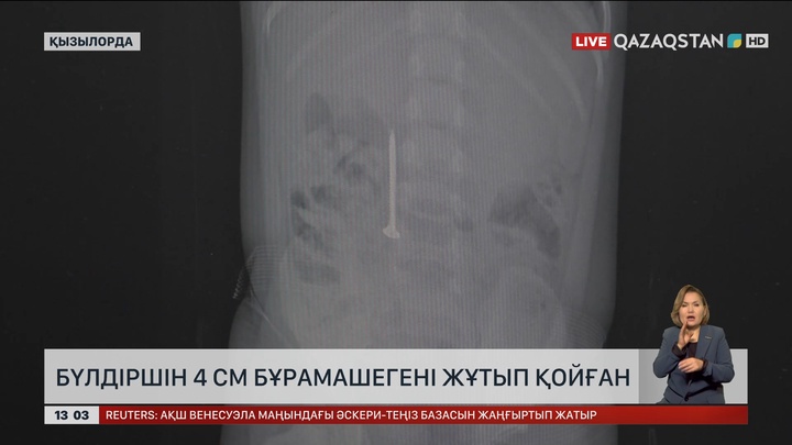 Қызылордада шеге жұтып қойған балаға ота жасалды