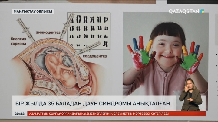 Маңғыстауда бір жылда 35 баладан даун синдромы анықталған