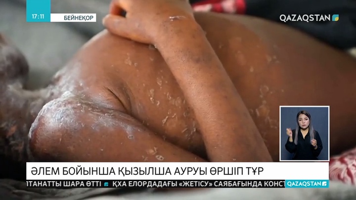 Қызылша ауруына шалдығу оқиғалары 3 есе көбейді