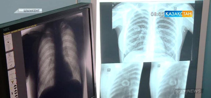 Туберкулезге шалдыққандар саны азайып келеді